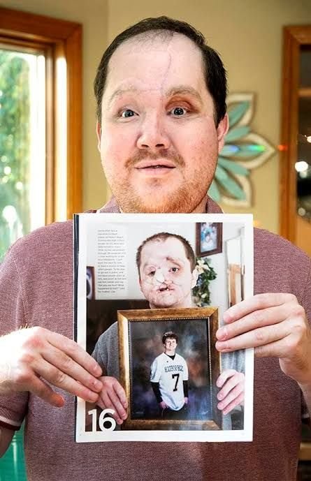 Family sees God's hand in son's survival after suicide attempt, successful face transplant - Catholic Review